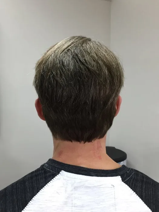 Hair restoration client, after, back view