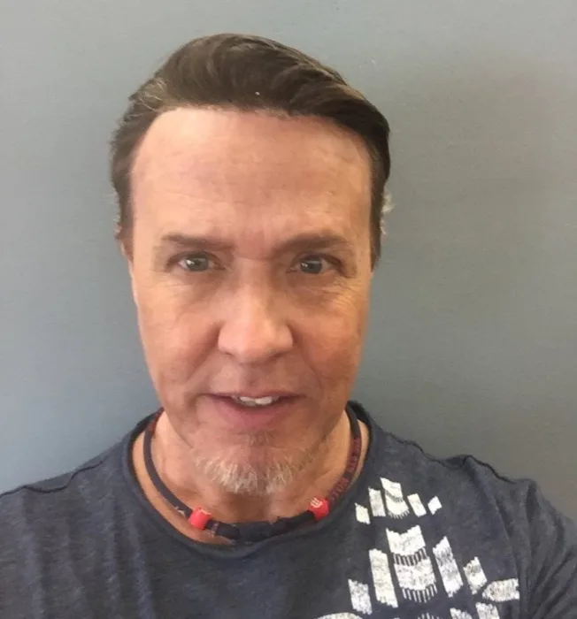 Hair restoration client, after, front view