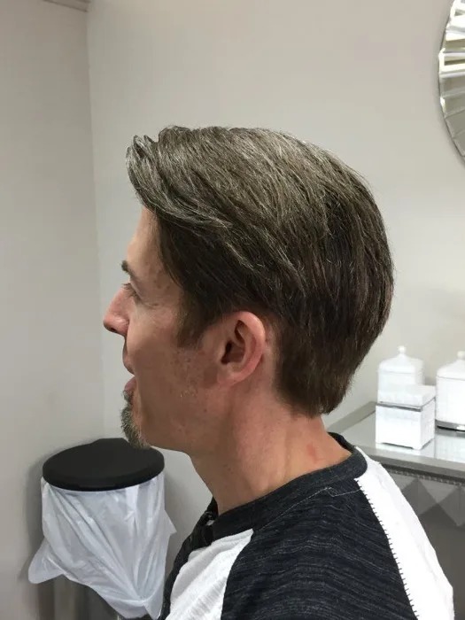 Hair restoration client, after, side profile