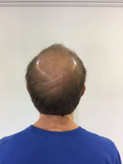 Hair restoration client, before, back view