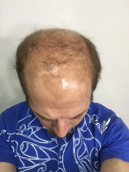 Hair restoration client, before, close detail