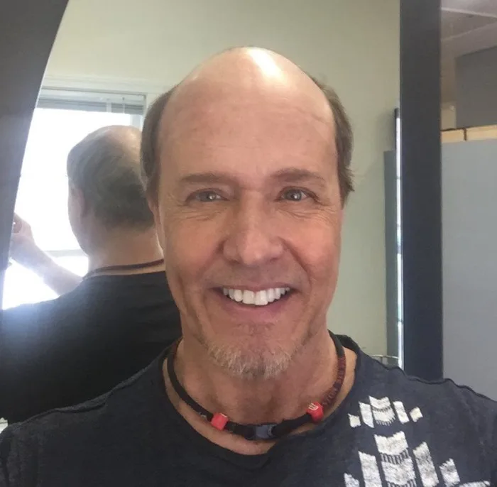 Hair restoration client, before, front view