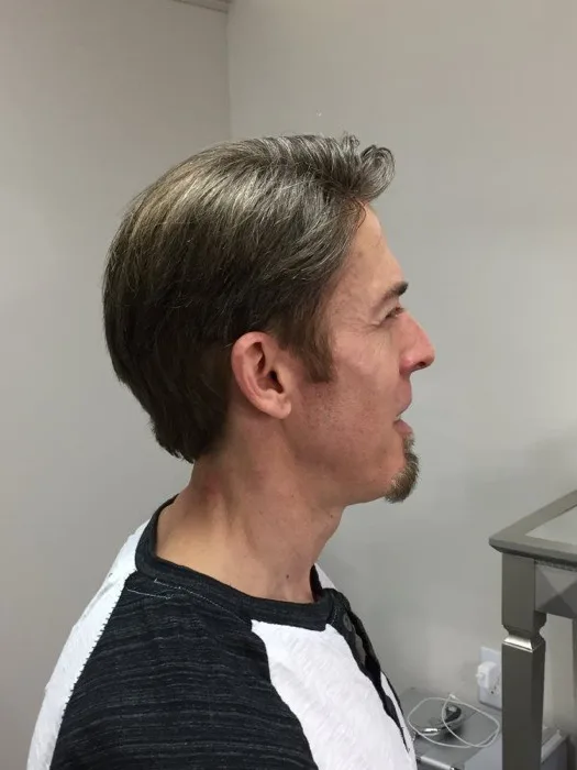 Hair restoration client, before, side profile